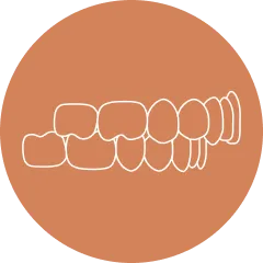 オーバーバイト